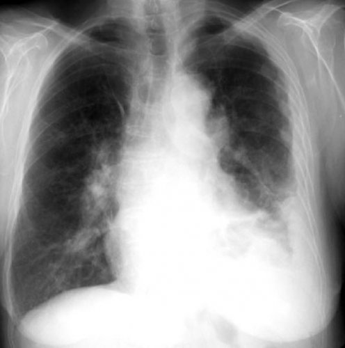 Asbestos Settlement Archives - Mesothelioma Legal Blog Congratulations to my friends