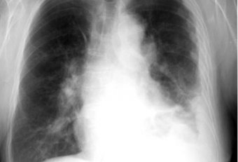 Travelers direct action asbestos